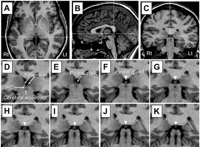 Pineal Gland Volume in Major Depressive and Bipolar Disorders